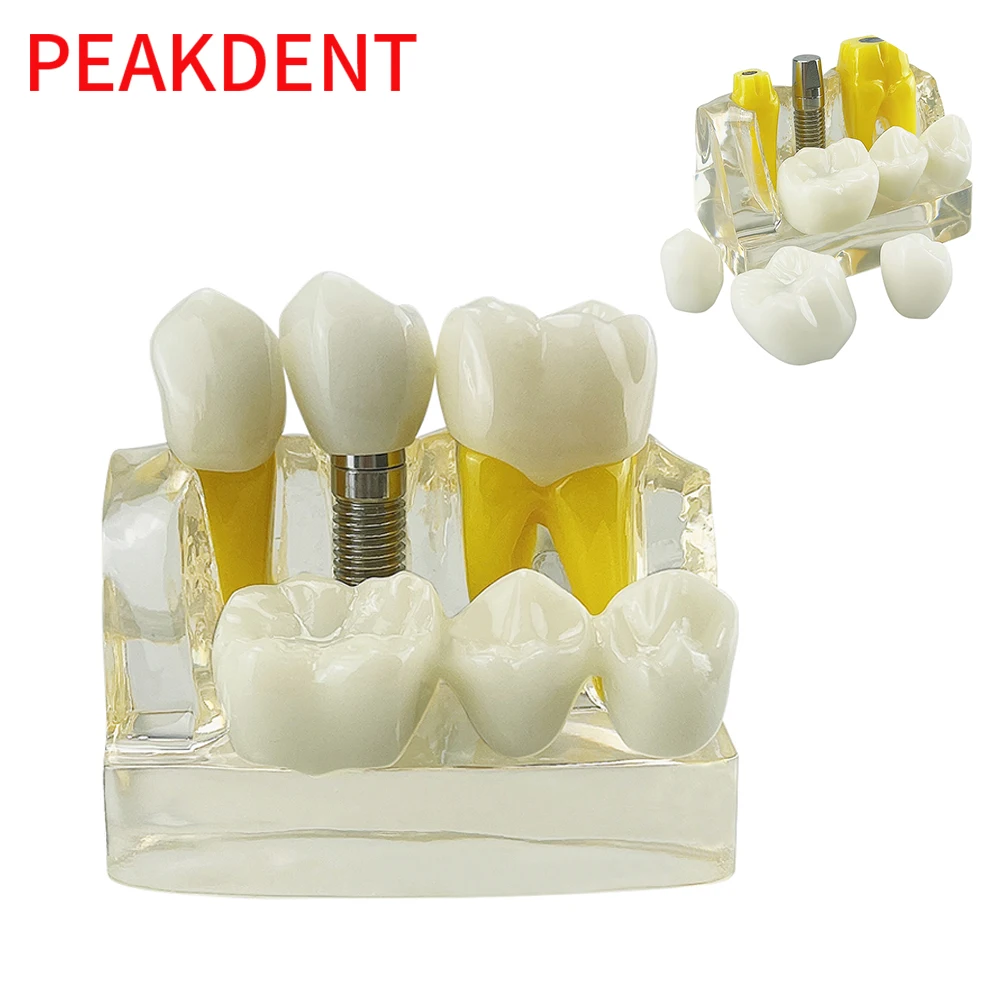 Dental Implant Model Dental Teaching Tools 4x Implant Explanation Split Model mplant Analysis Crown Bridge Removable Model