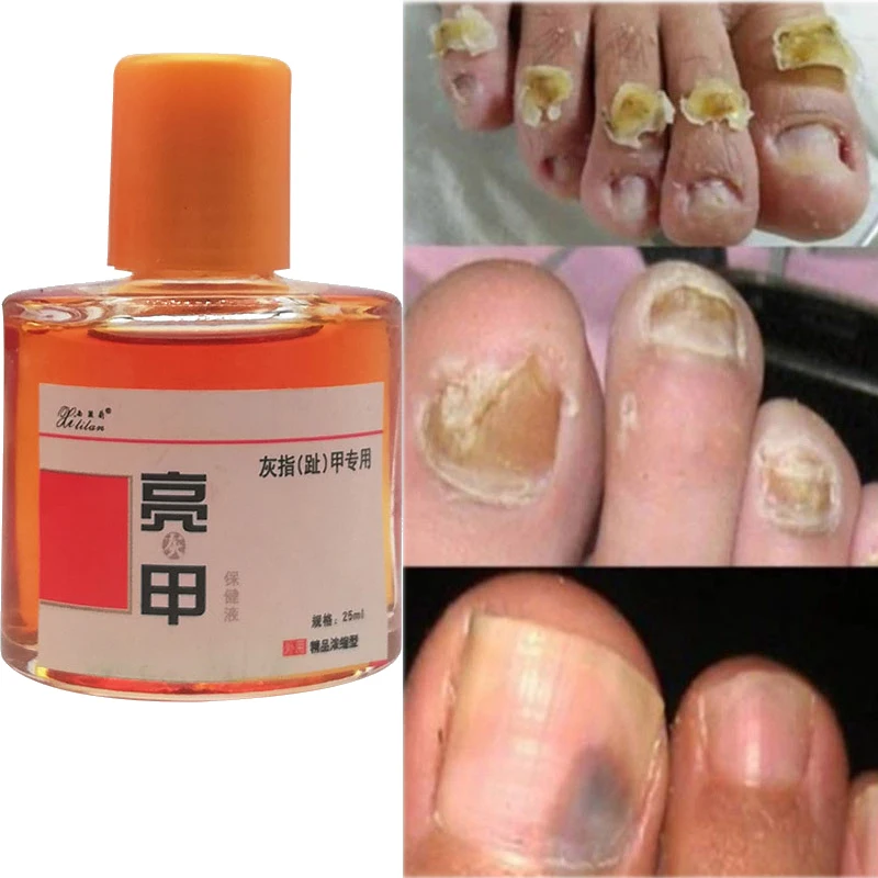 3/5pcs Toenail Fungus Removal Serum SKU:YG-568x3@#SMT1315yjz