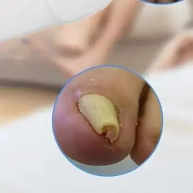 

Professional Nail Fungus Removal Device, Laser Care Machine for Toenail & Fingernail Maintenance with 470nm+905nm Wavelength