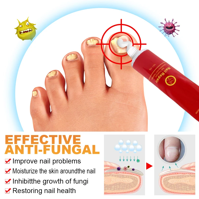 10g Nail Fungus Removal Cream Onychomycosis Fungal Ointment Nail Paronychia Cream Anti Feet Toe Fungal Toenail Care Ointment