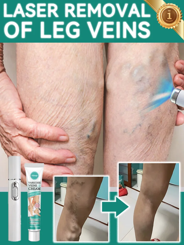 

Hot sale Nano Laser Leg Vein