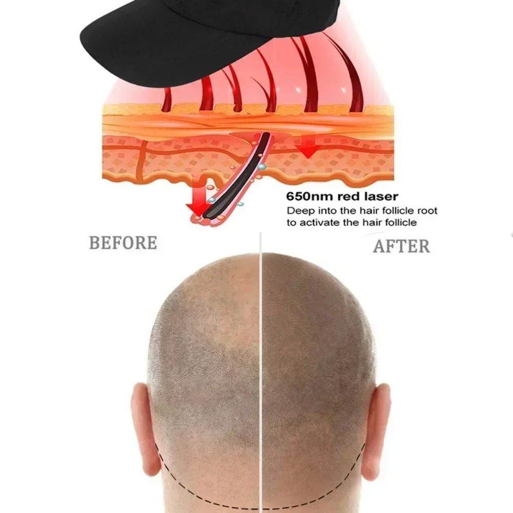 Bonnet de thérapie à la lumière rouge pour la croissance rapide des cheveux, chapeau de soin du cuir chevelu, anti-chute de cheveux, repousse infrarouge, relax, 660nm, 850nm, 96 pièces