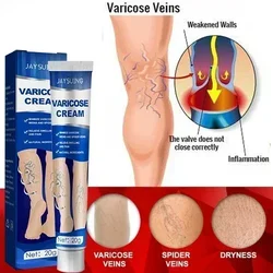 Effective Relief Varicose Vein Ointment Relieve Varicose Vein Vasculitis Spider Legs Pain Care