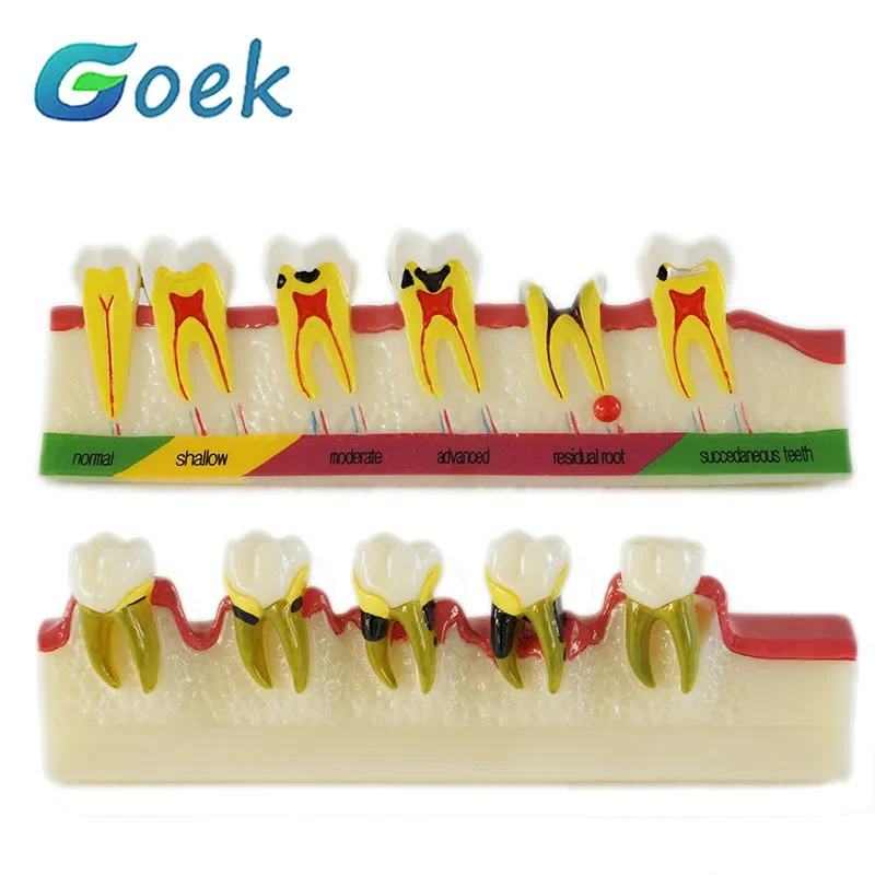 Dental Teaching Model Caries Developing Peridontal Diseases Different Periodontic Diseases Dentistry Accessories Laboratory Tool