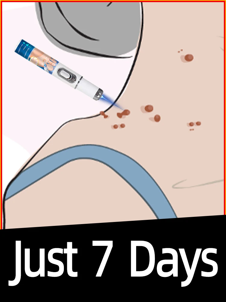 Strumento per la luce blu verruca, più sconti su set, penetrazione delicata, ripristino dell'illuminazione naturale