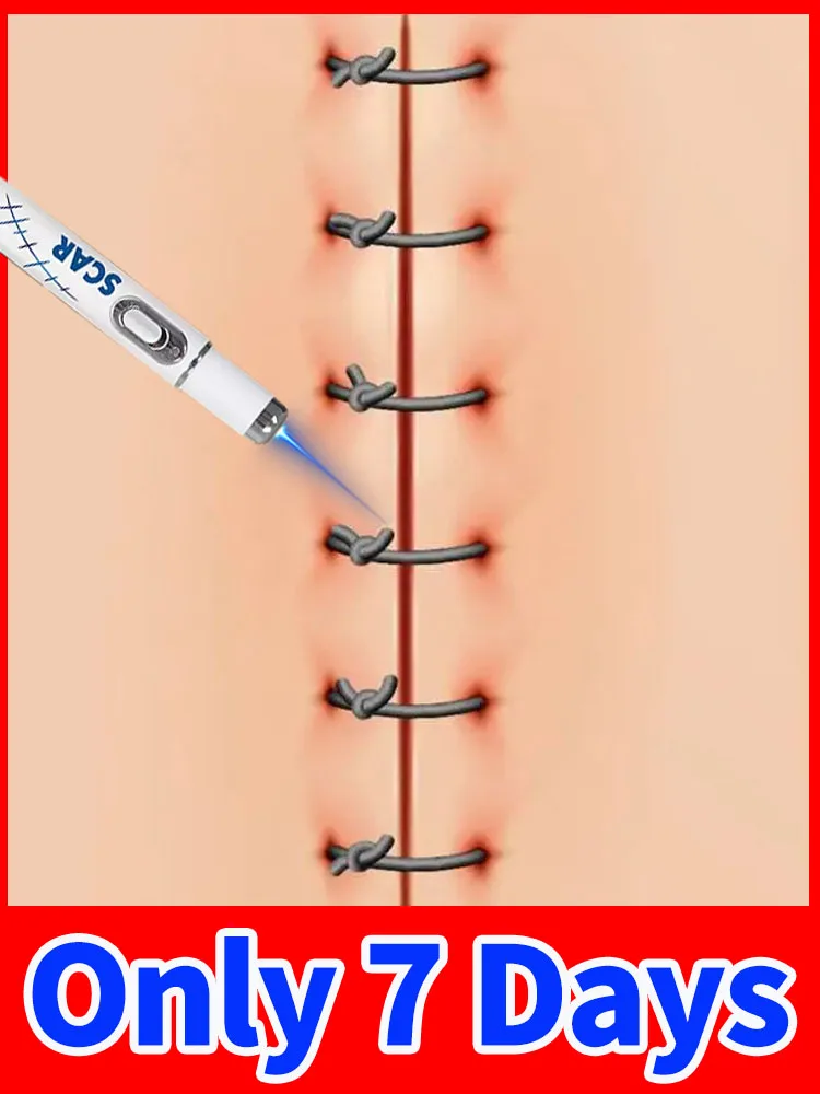 

Generation-2 Laser Effectively Remove Various Scars in 7 Days