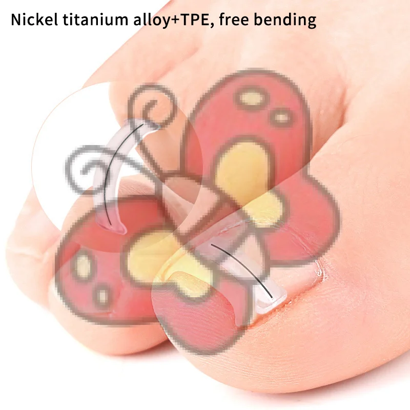 Autocollants correcteurs d'ongles incarnés, 2 pièces, patchs de traitement Paronychia, correcteur de récupération, outils de pédicure, soins des pieds