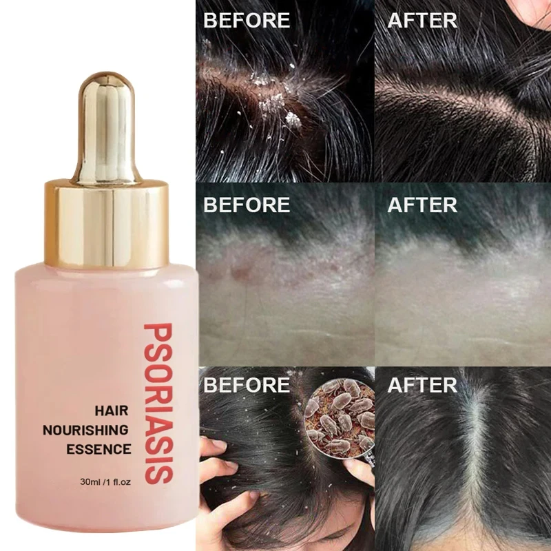 30ml Hair Treatment Remove Dandruff And Relieve Essence Prevent Loss Serum Oil Control Smooth Nourish Repair Hair Scalp Care