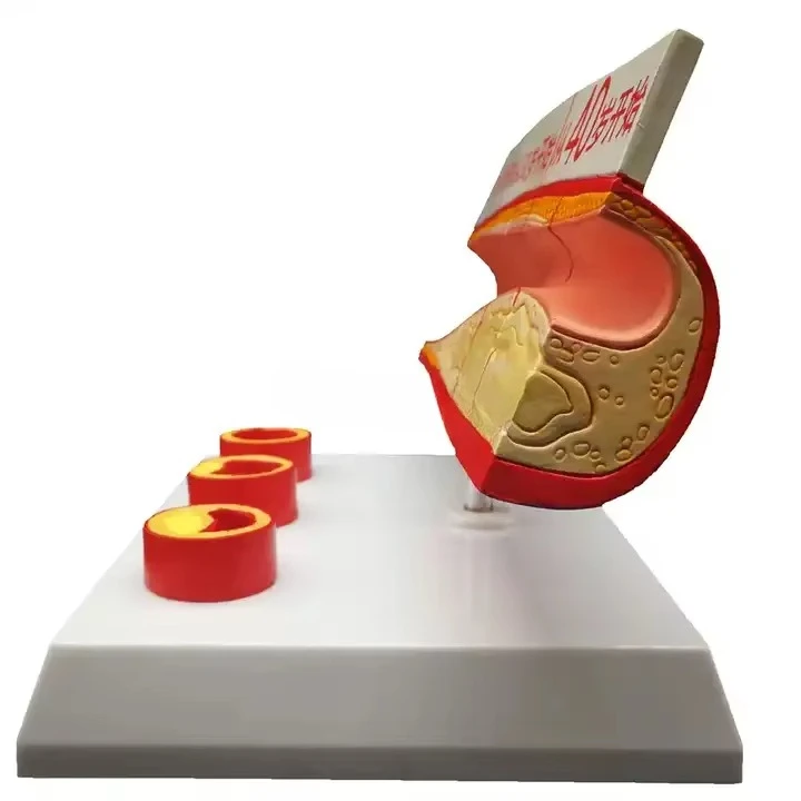 Anatomy Teaching of Coronary Atherosclerosis Thrombosis Model in Medical Disciplines