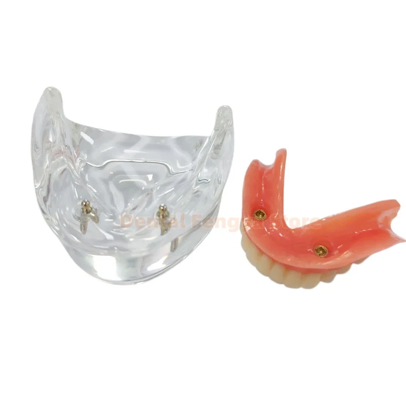 1Pcs Clear Dental Teeth Model Covered Dentures With 2/4 Implant Nail Models Upper/Lower Dental Teaching Demonstration Model