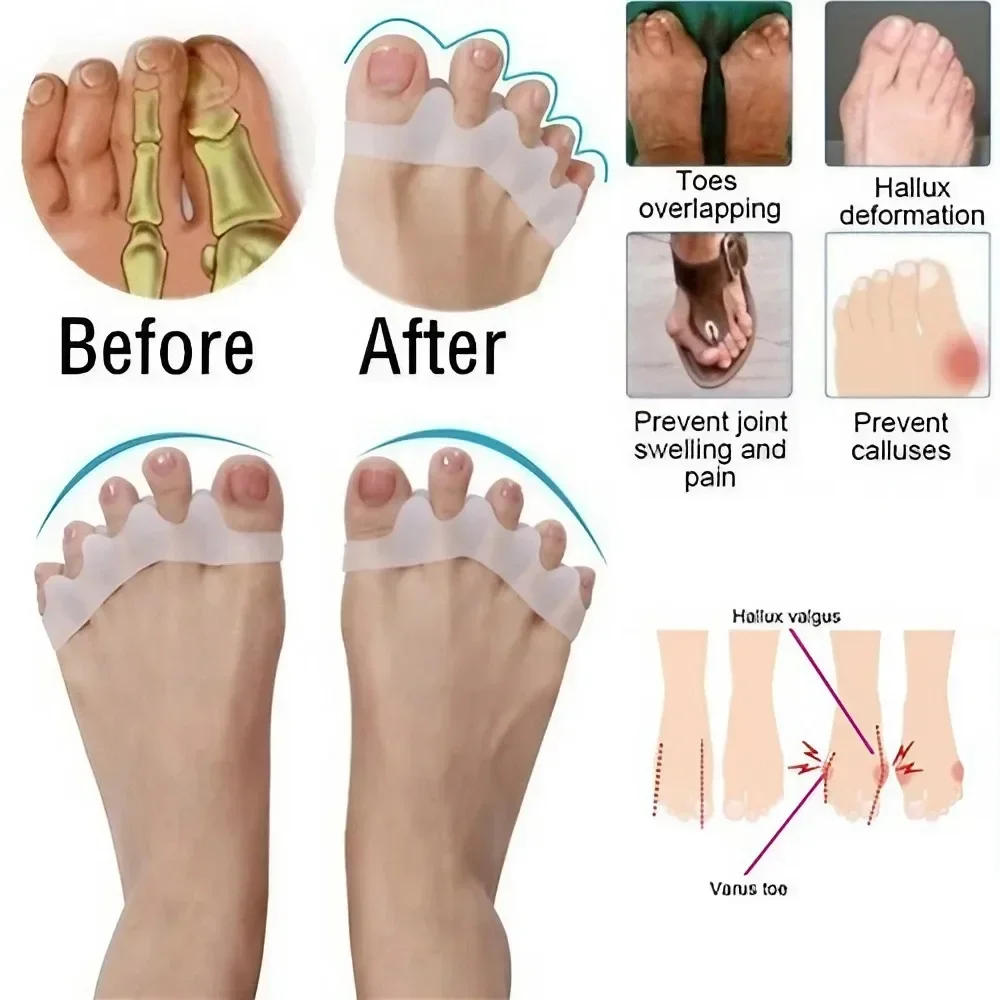 STONEGO Siliconen Hallux Valgus Corrector Teenseparators Bunion Correctors Voet Vinger Splitter Orthopedisch Apparaat voor Voet Bot