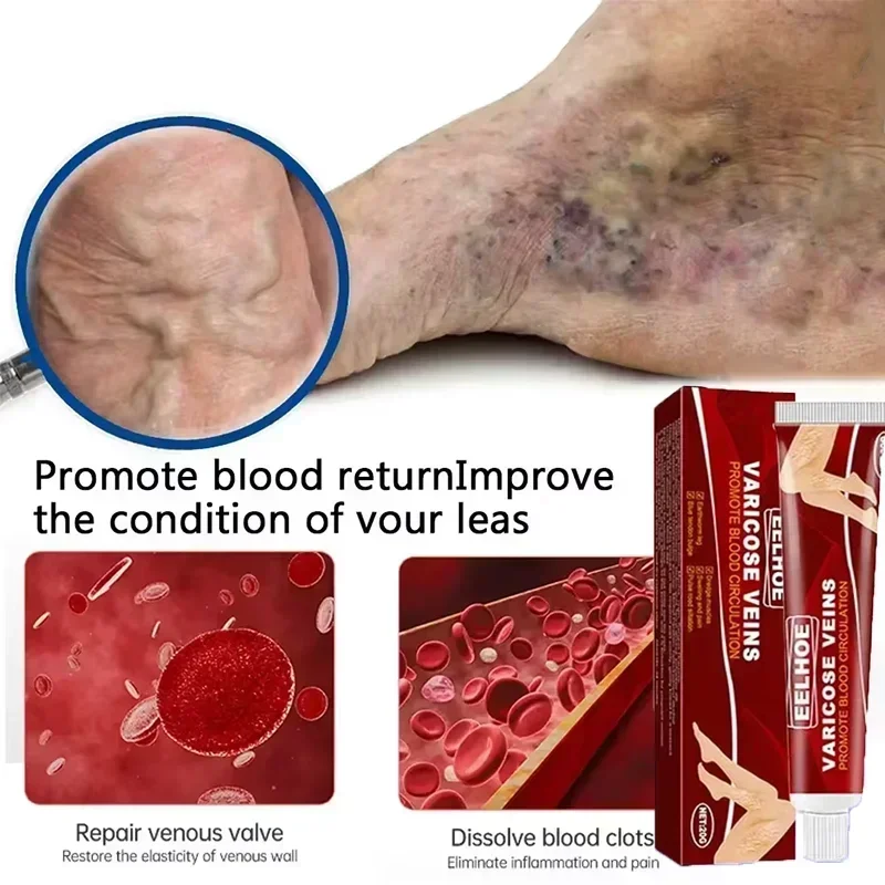 

Varicose Veins Effective Relief Of Dilated Vasculitis In The Legs Phlebitis Improved Blood Circulation