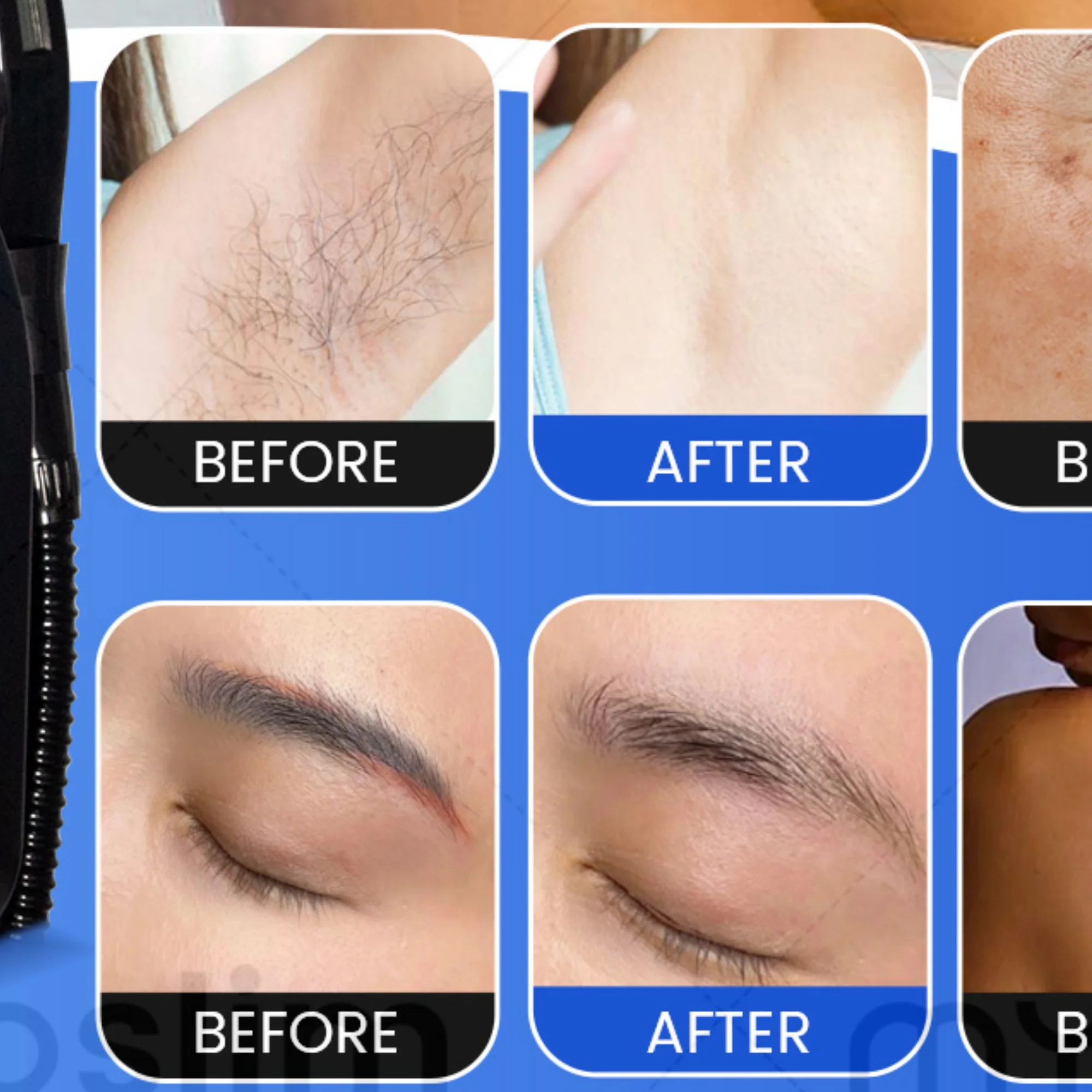 

4-in-1 Soprano Diode Laser Hair Removal Device 755 808 940 1064nm ND:YAG+RF+IPL Painless Hair Removal and Tattoo Removal