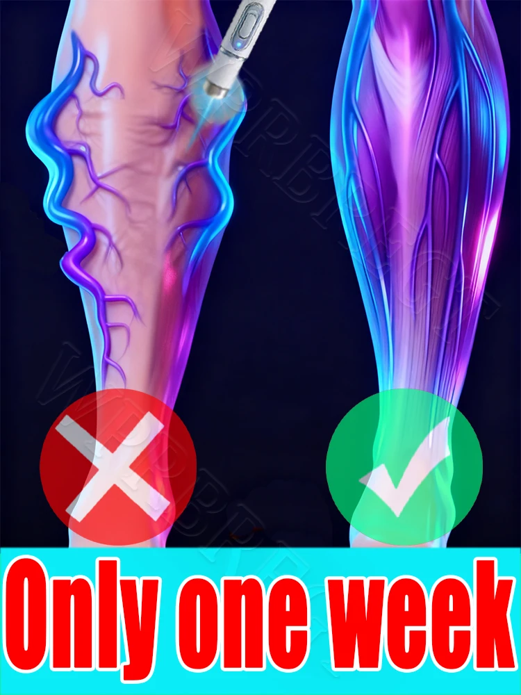 

Lᴀsᴇʀ ɪɴsᴛʀᴜᴍᴇɴᴛ ᴠᴀʀɪᴄᴏsᴇ ᴠᴇɪɴ ᴘᴇɴ