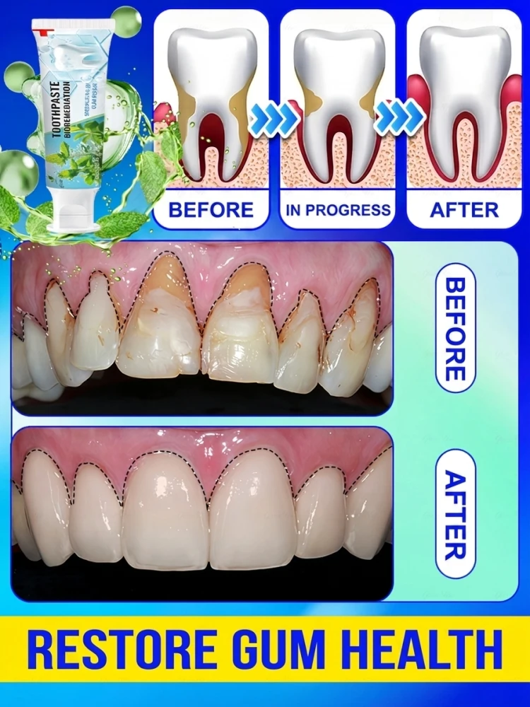 Intensive Probiotic Gum Care Toothpaste Treatment for Swollen Bleeding Gums Relief Sensitive Teeth Whitening Stain Remover Anti Bad Breath Fresh Breath Long Lasting Deep Oral Cleaning Dental Hygiene Paste Product for Adult Care 60g