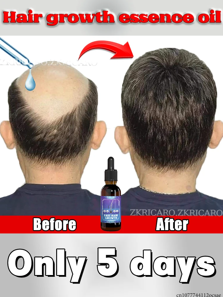 

ZKRICARO 0 Официальная подлинная, высококачественная эссенция для роста волос 0il, уход за кожей головы, делает волосы растирают толще, больше никакой