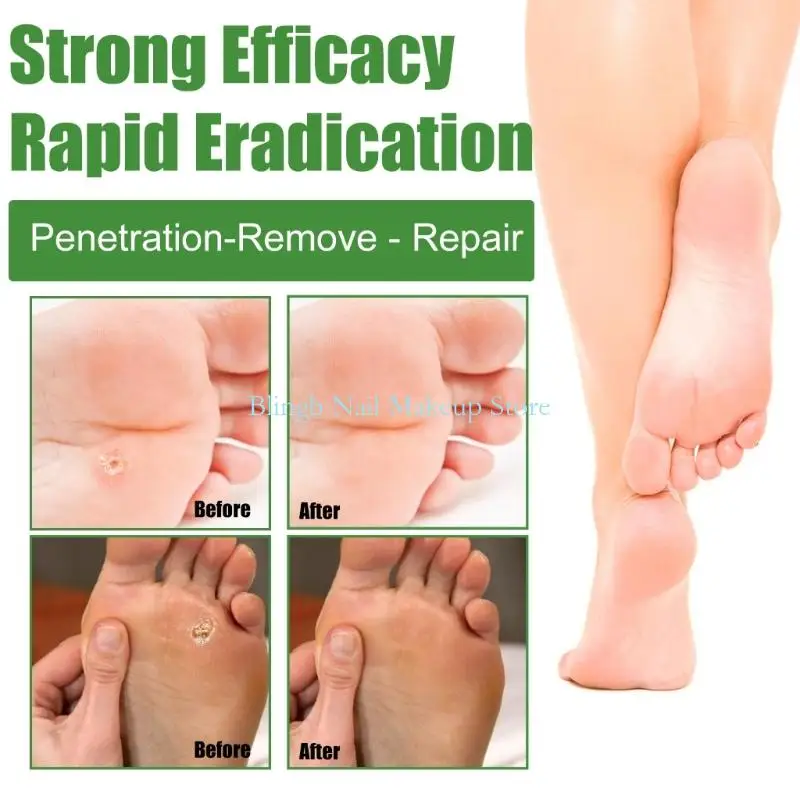 

28TA Herbal Foot Warts Remover Patches For Deep Cleansing And Improved Circulations With Natural Ingredient