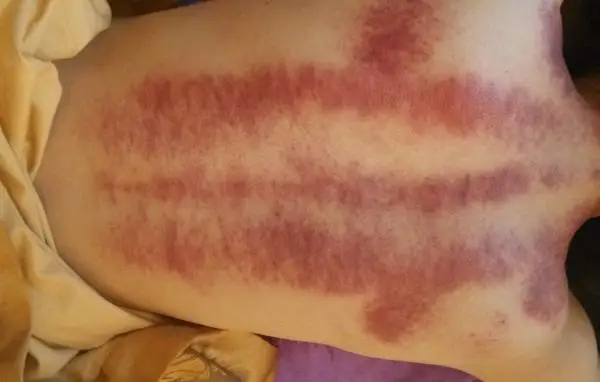 Schoonheid Quick Body Vorm Cellulitis Vermindering Vacuüm Stimulator