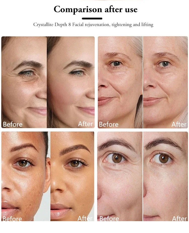 Nano Fractional RF Tip Epidermal Rejuvenation Gentle Skin Repair Post-Treatment Soothing Beauty Use
