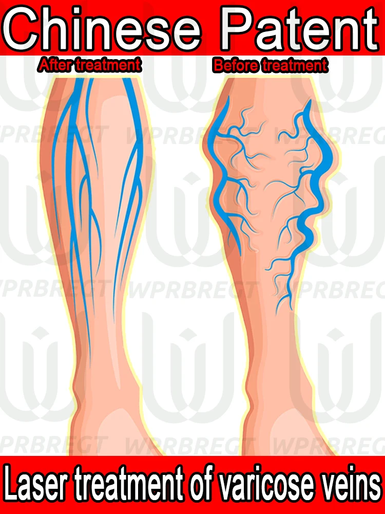 

Treat varicose veins painlessly and safely eliminate venous swelling