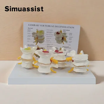 4-traps pathologische menselijke lumbale wervelkolom anatomie model medische wetenschap leermiddelen