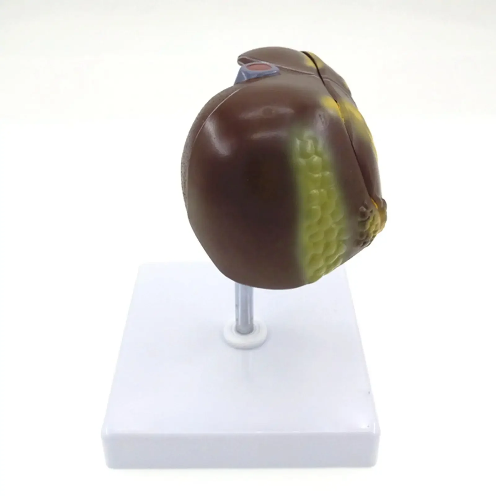 PVC Diseased Liver Anatomica Medical Model Stone Specimens Fatty Liver Teaching Aids