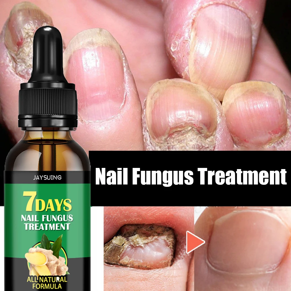 Nail Fungal Treatment Essential Oil Foot Toe Nail Fungus Removal Serum 7 Days Repair Onychomycosi Anti Infection Care Products