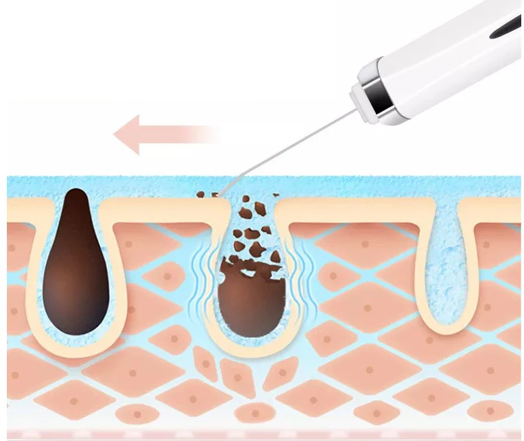 ผลิตภัณฑ์ผลัดเซลล์ผิวหน้าสำหรับใช้ที่บ้าน/สครับขัดผิวขายดีเพื่อการยกกระชับและขจัดสิวเสี้ยน