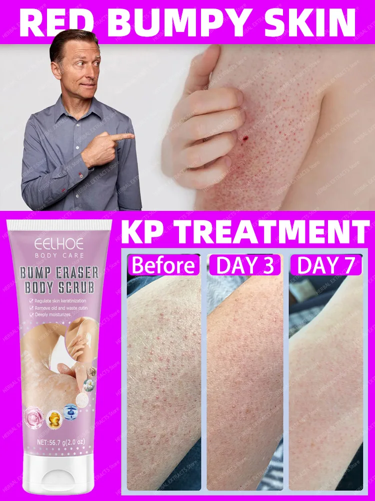 Keratosis Pilaris Cream  Rough Goosebumps Tiny Bumps Red Bumpy Chicken Skin Removal