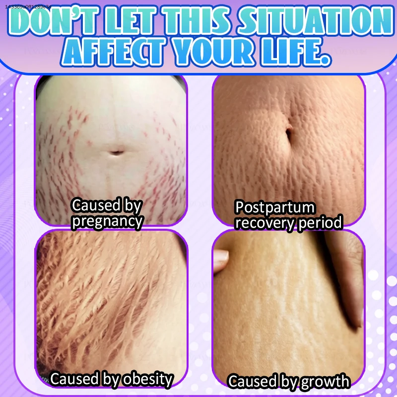Stubborn Maternity Blemish Destroyer Fast Belly Firming Liquid Rescue Shrink Loose Skin After Birth Deep Dermis Repair Oil Extreme Stretch Mark Minimizer Dark Spot Fader Smooth Tight Contour Treatment Clinical Postpartum Beauty Care Serum