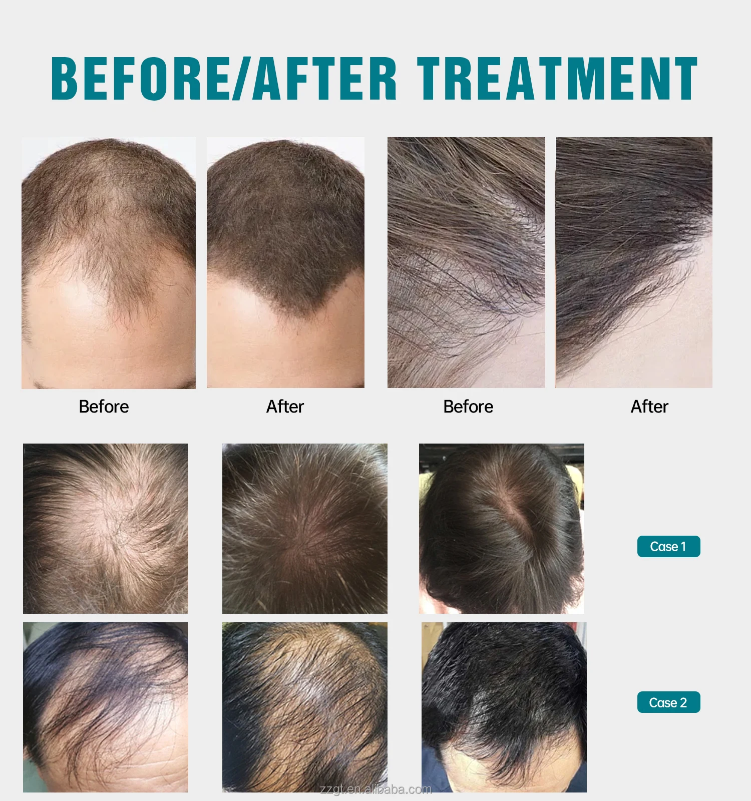 312-Dioden-Haarwuchshelm, Rotl – Hair Care Wella Bewertung und Preis