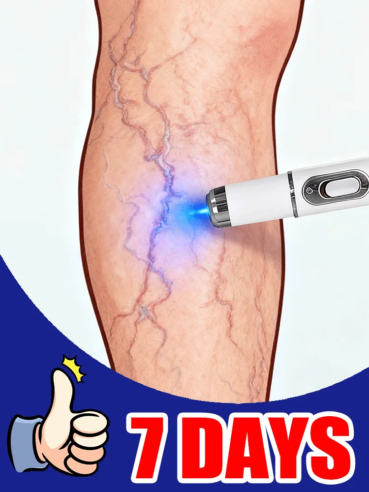 การปรับปรุงการไหลเวียนโลหิต ผลิตภัณฑ์ดูแลผิวปากกาสำหรับเส้นเลือดขอด