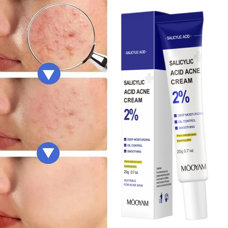 Salicylic Acid Acne Treatment Cream Remover Deep Scars Acne Prone Skin Repair Gel Oil Control Shrink Pore Blackhead Cleaner Care