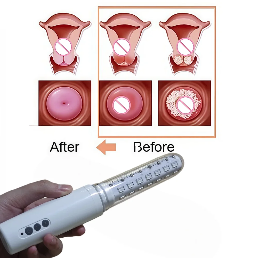 

Устройство для подтяжки влагалища для домашнего использования, оборудование для холодной лазерной терапии для женщин, лечение вагинита и антибактериальное здравоохранение