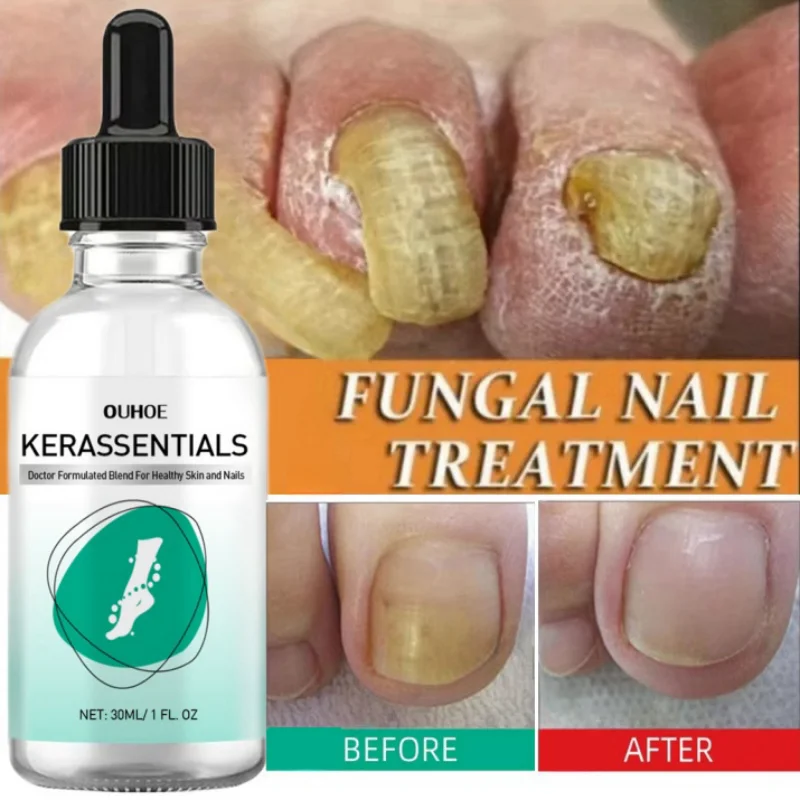 Fungal Nail Treatment Essence Oil Nail Fungus Laser Device Repair Toenail Fingernail Treatment Onychomycosis with Mushrooms 30ml