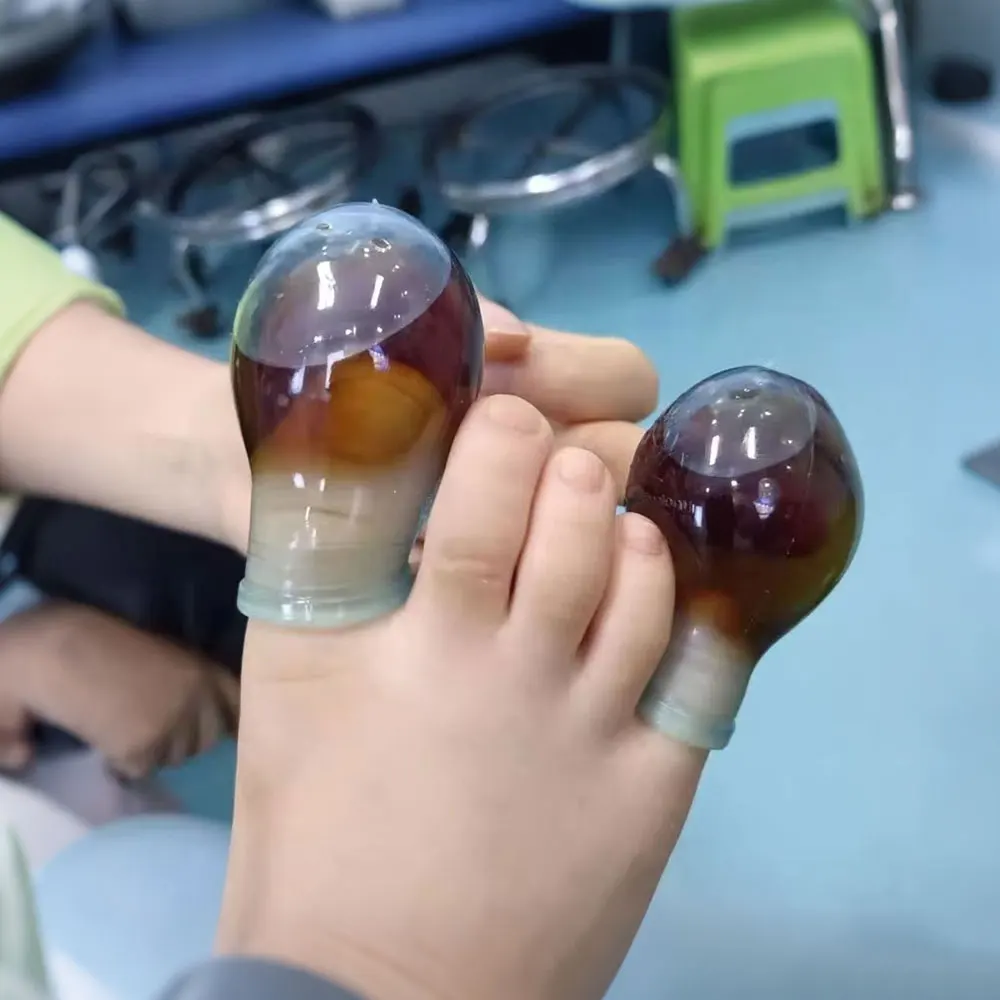 

1-10Pc Soft Silicone Toe Sleeves Toe Protectors, Reduce Friction Prevents Nail Insertion for Wound Care and Cutaneous Infections