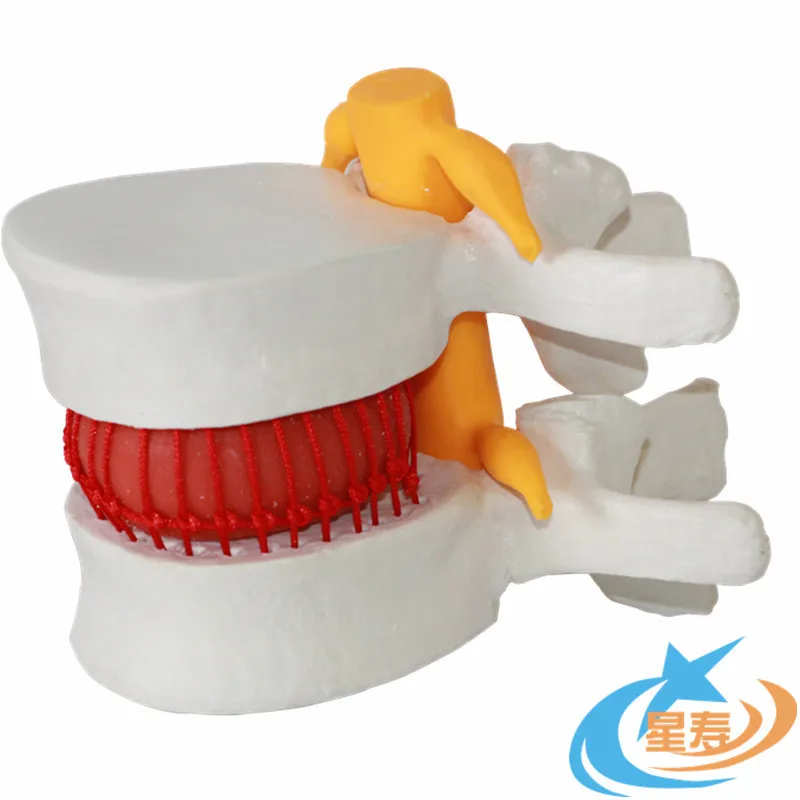 Demonstration model of lumbar disc herniation, lumbar model, intervertebral disc model, lesion lumbar model