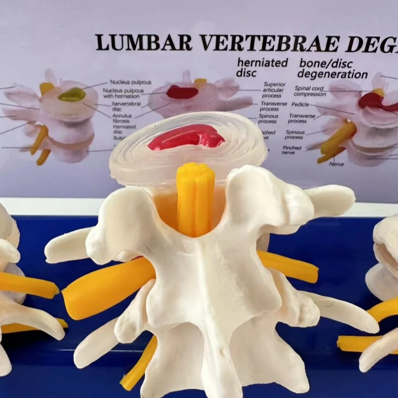 A four-stage model of disc herniation compression from healthy to herniated