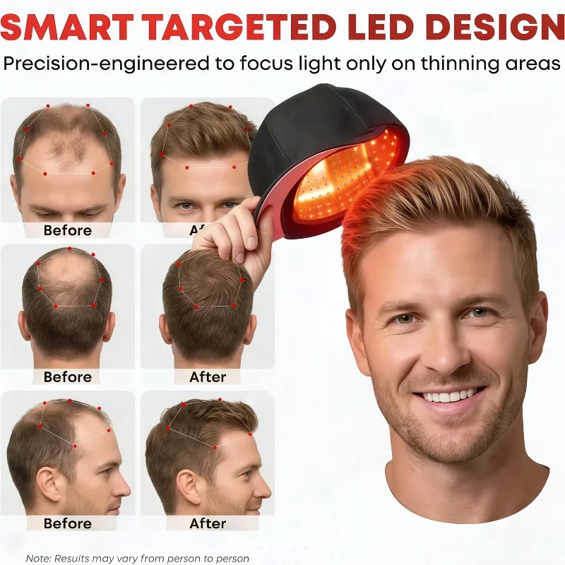 Best 96 Diodes LLLT Laser Hair Regrowth Cap, Hair Restoration Enhance Therapy Scalp Coverage Caps for Men 510K