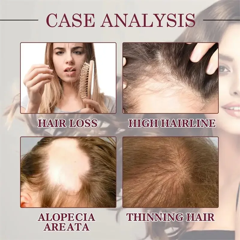 Sérum de croissance rapide des cheveux, huile essentielle Anti-perte de cheveux, réparation du cuir chevelu endommagé, femmes et hommes, soins Anti-calvitie