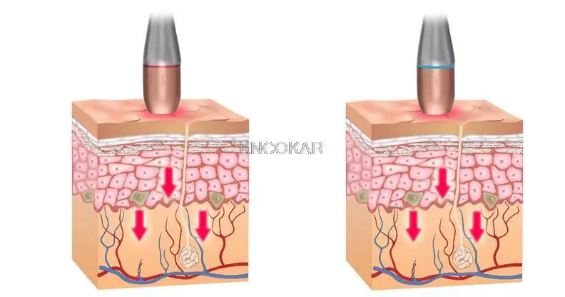 آلة نحت خط الرادار بالموجات فوق الصوتية الجديدة على شكل حرف V لشد بشرة الوجه ورفع جهاز تجميل أدوات العناية ببشرة الوجه