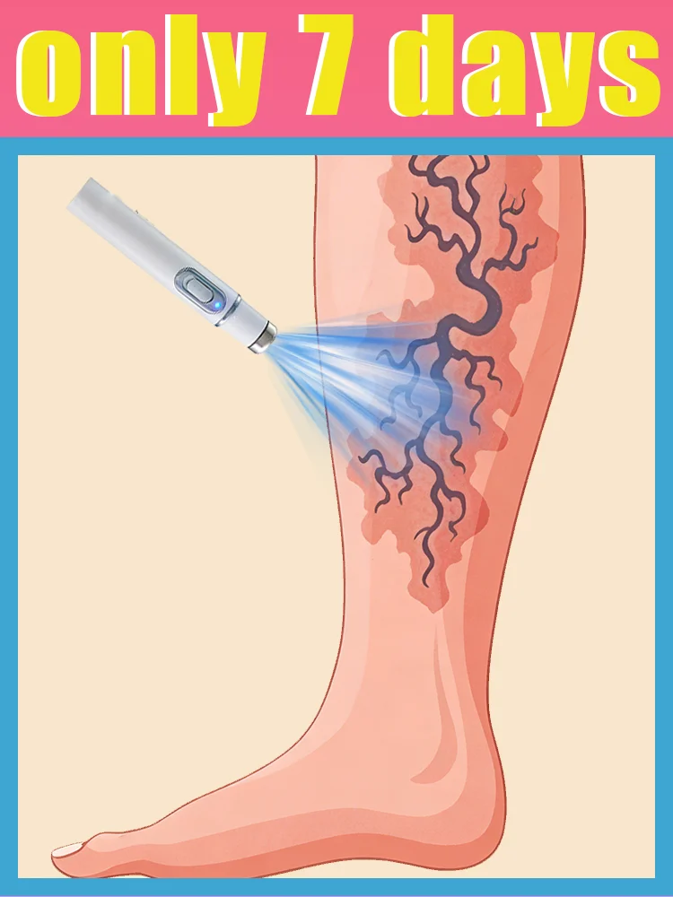 

Rᴇʟɪᴇᴠᴇs ᴘᴀɪɴ ɪɴ ᴠᴀʀɪᴄᴏsᴇ ᴠᴇɪɴs ᴀɴᴅ ʀᴇᴅᴜᴄᴇs "sᴘɪᴅᴇʀ ʟᴇɢs"—sᴜᴘᴇʀ ᴘʀᴀᴄᴛɪᴄᴀʟ!