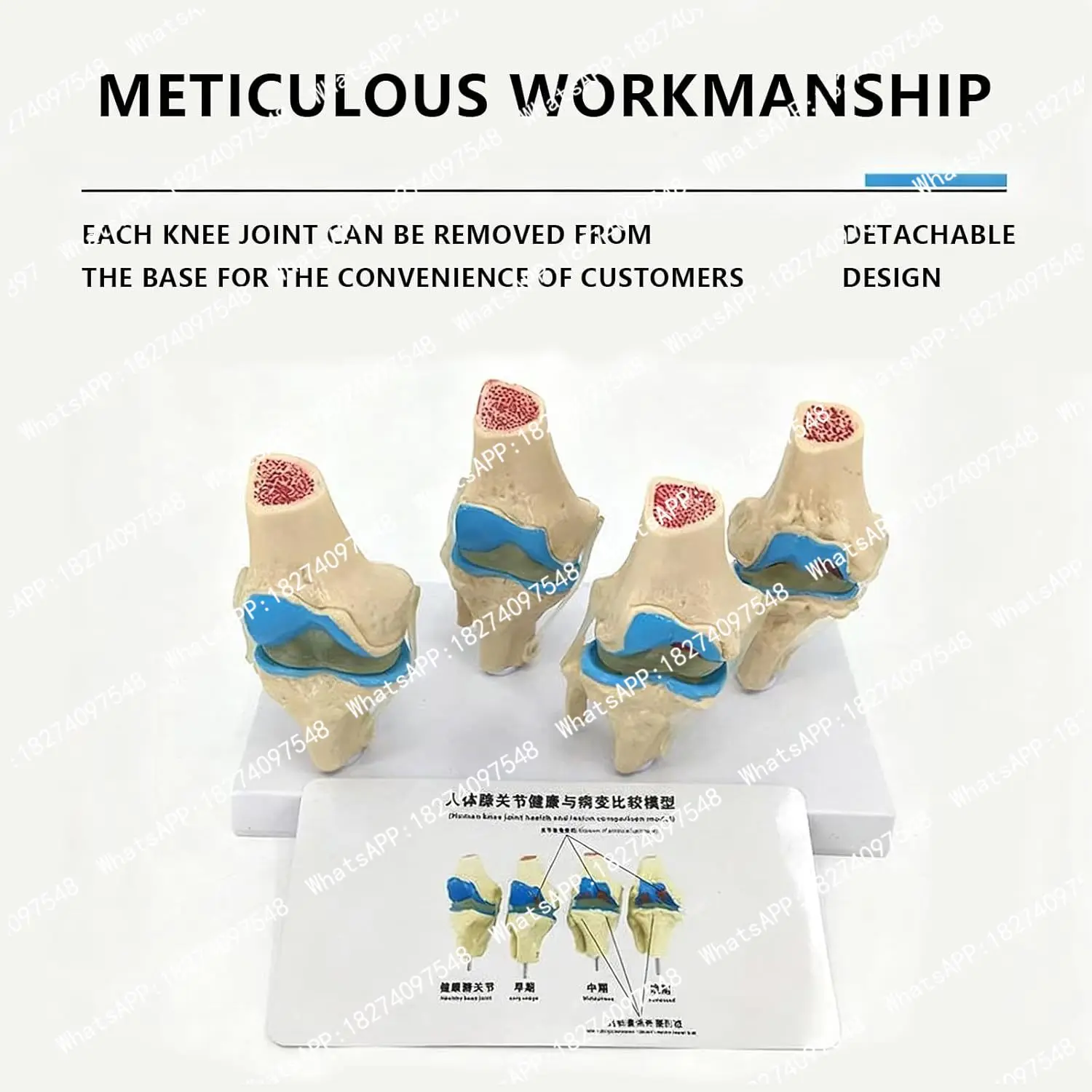 4-stage Knee Joint Model Plastic Bone Pathology Knee Anatomical Model PVC Bone Medical Skeleton Anatomy Teaching Model