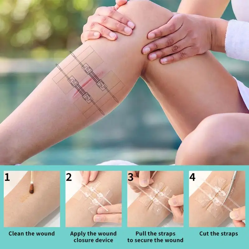 Adhesive Wound Care Zip Sutures Bandaids Without Stitches First Aid Zipper Laceration Repair Emergency Laceration Closures