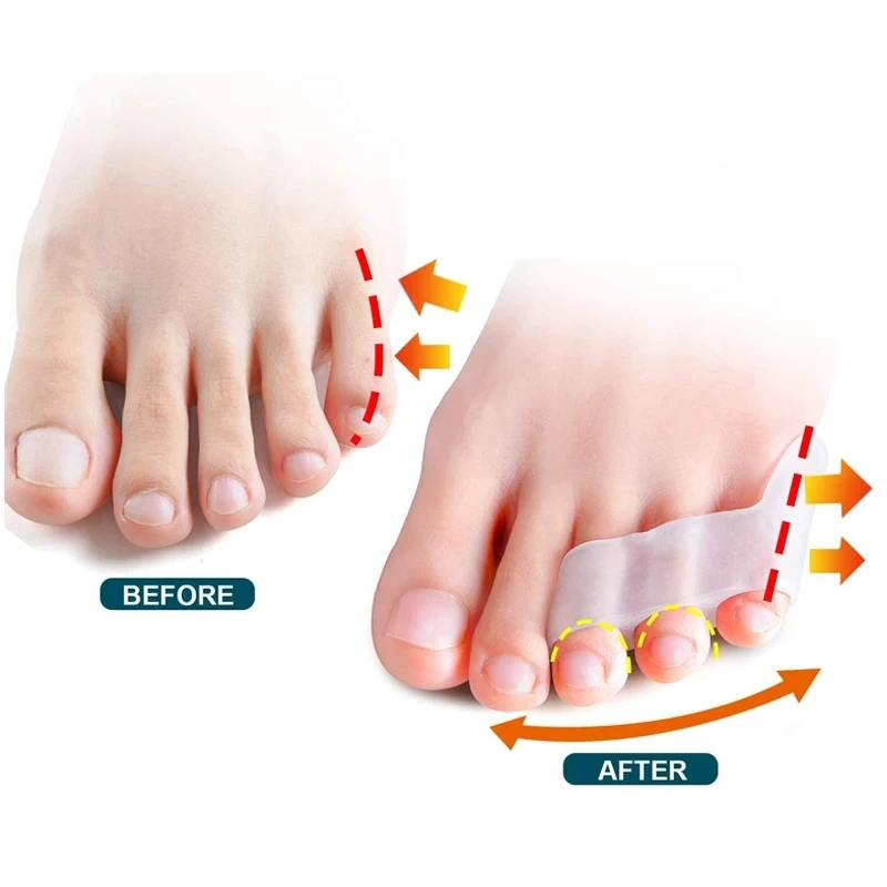 4pcs=2pair New Protective Toes Separator Suitable Bunion Corrector Material Soft Gel Straightener Spacers Stretchers Care Tool