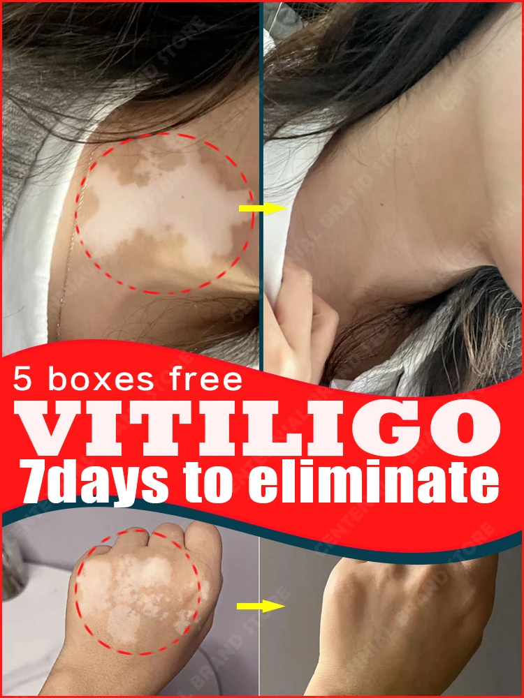 Eliminação da vitiligo da pele