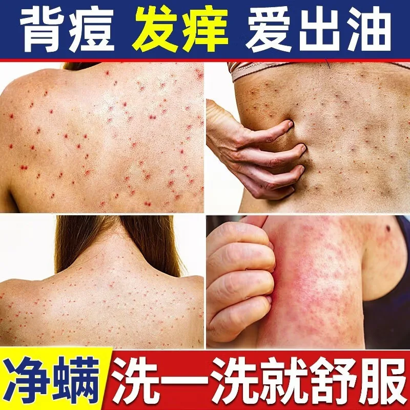 Lavagem corporal à base de enxofre Nanjing Tongren Tang | Remoção de caspa e ácaros | Limpeza de manchas para as costas | Suave na pele | Fórmula de ervas