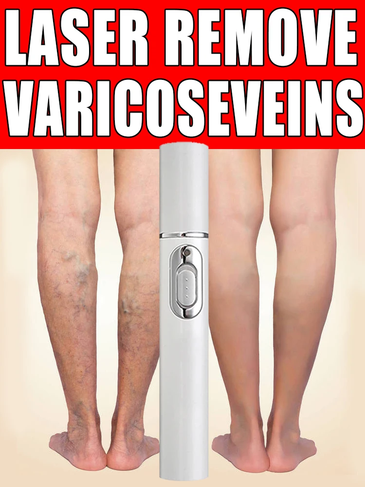 Mejora de venas varicosas