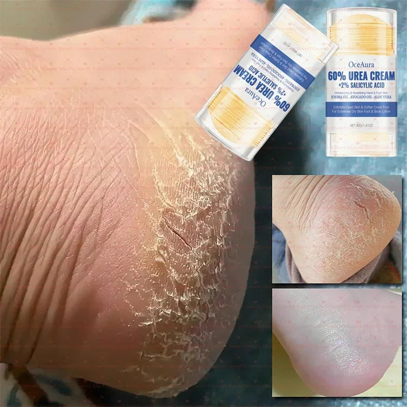 

60% Urea Foot Cream Aloe Vera Ultra-Hydrating Softening Dry Cracked Feet Cream Gentle Exfoliation Daily Foot Care Solution 40g