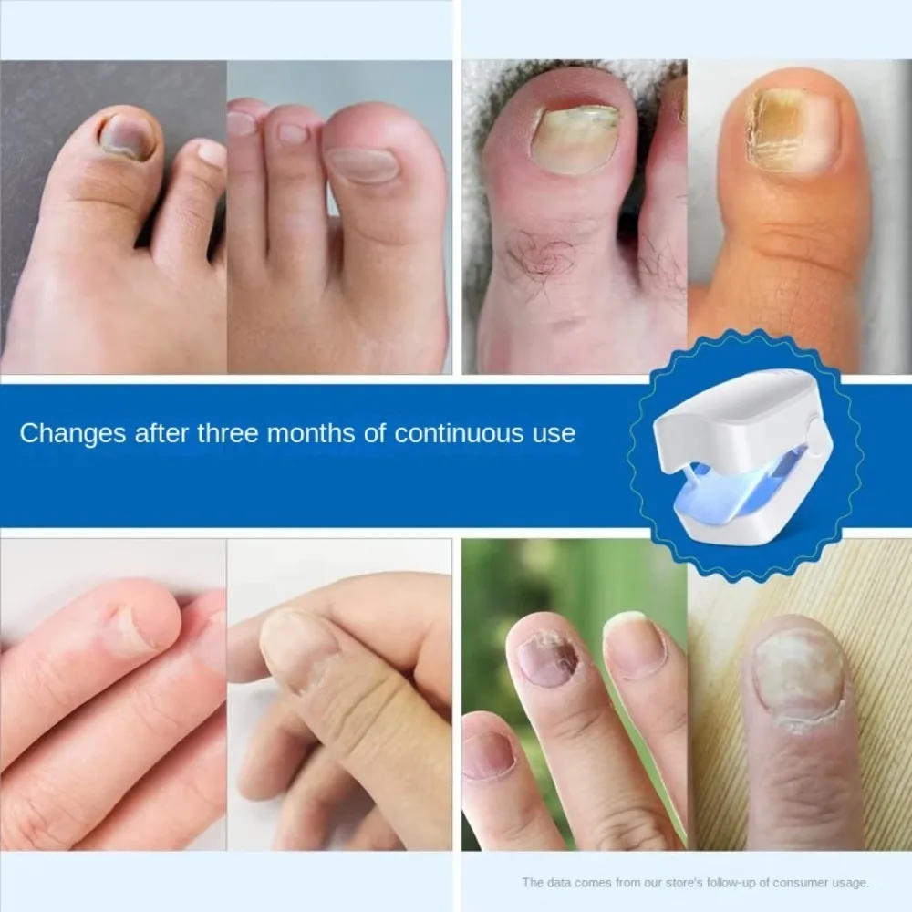 New Cleaning Laser Device Rechargeable Nail Treatment Tools Remove Remover Tool